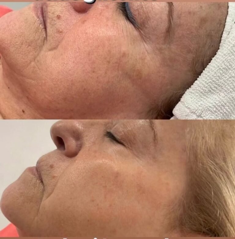 tratamientos faciales en Valencia